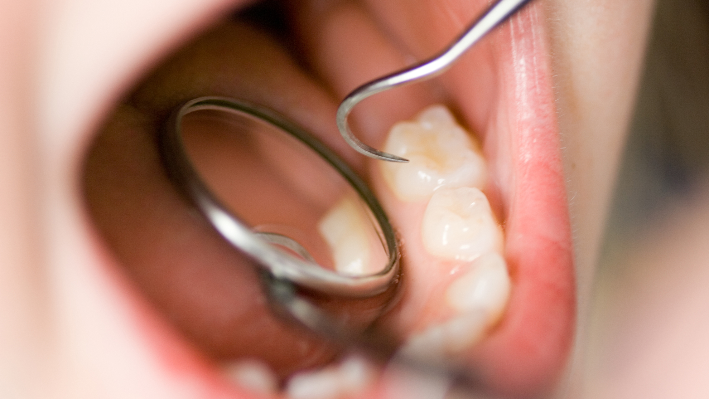 Molaren-Inzisiven-Hypomineralisation (MIH) – Wenn Zähne bröseln