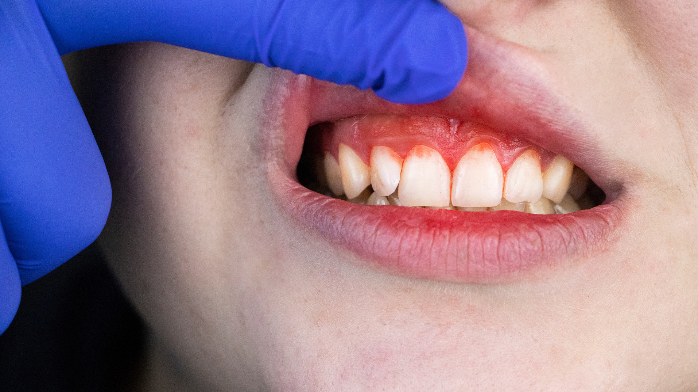 Zahnfleischbluten: Ursache und Behandlung