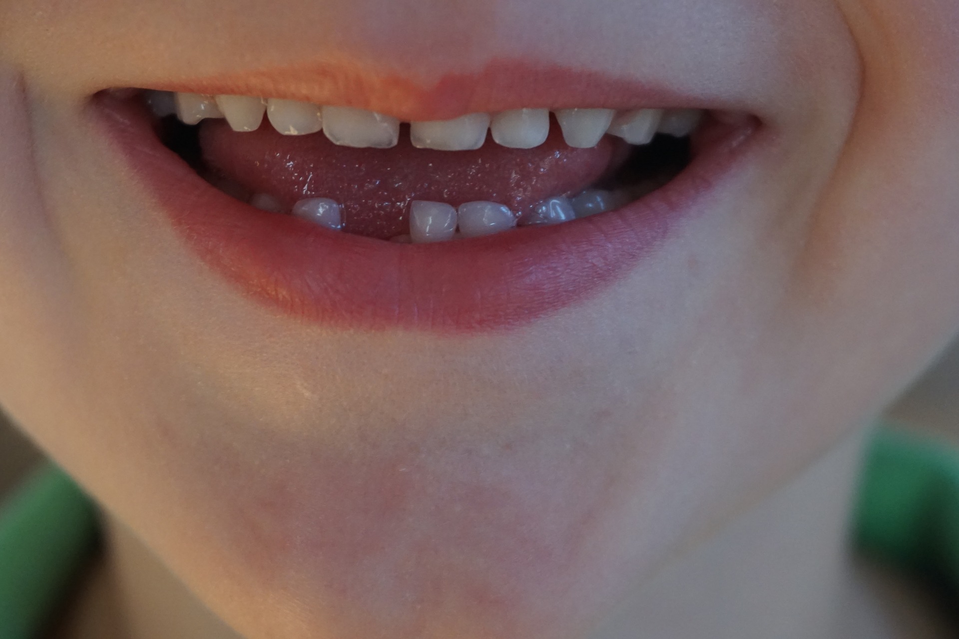 Hypodontie und Oligodontie - wenn Zähne von Geburt an fehlen